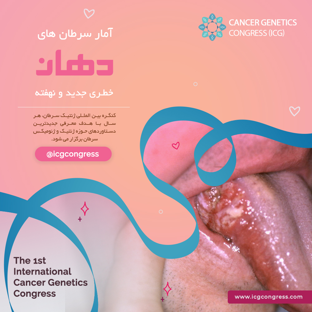 سرطان دهان - کنگره ژنتیک سرطان - کنسر ژنتیکس - کنسر ژنومیکس